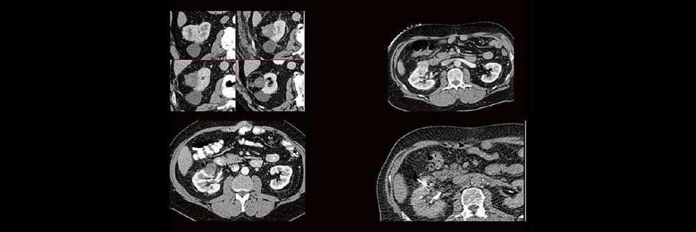 Thermoablation von Nierentumoren (Webinar | Online)