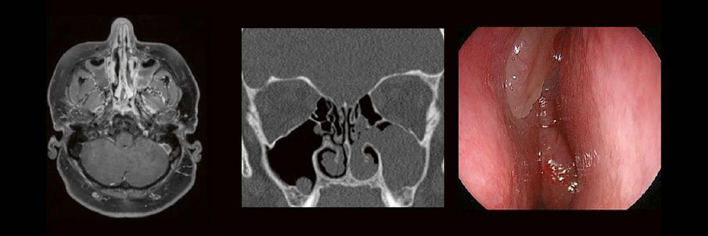 HNO & Radiologie: gemeinsam durch die NNH – ein Joint Venture (Webinar | Online)